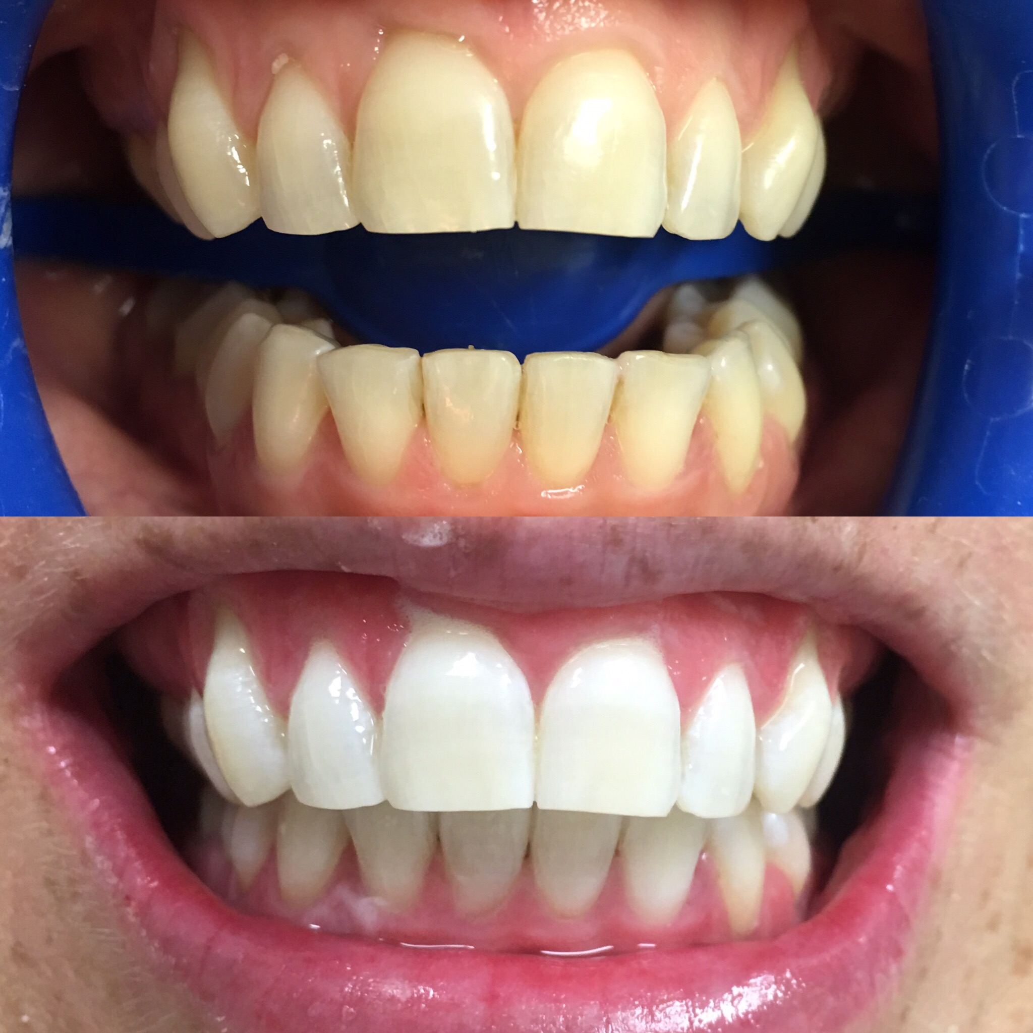 Zoom Whitening Results Dental At Coorparoo